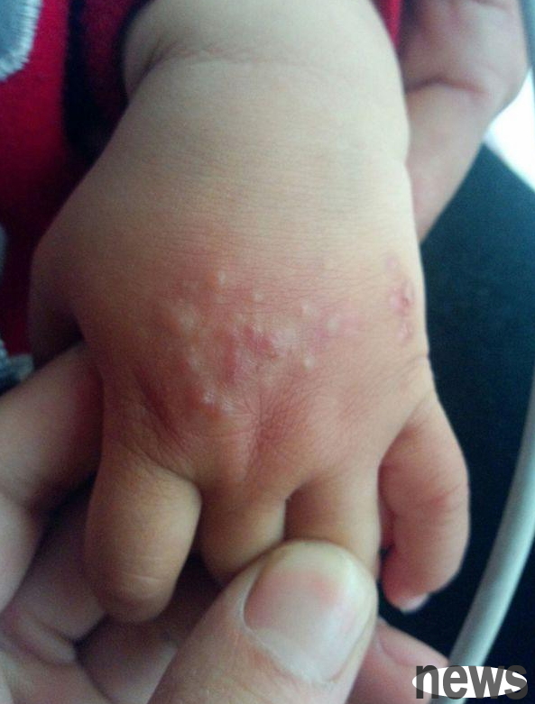 The child has bumps all over his body, and the culprit is his own dog!